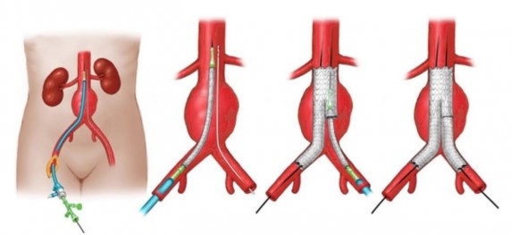 Endovascular Repair of Abdominal Aortic Aneurysms