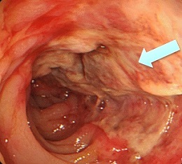 Ischemic Colitis