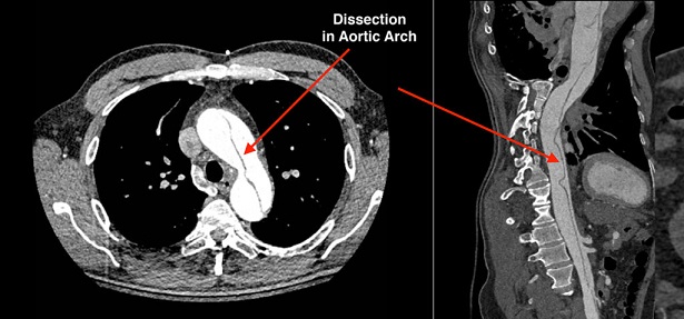 CT Scan - Aortic Dissection