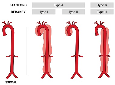 Classification of Aortic Dissections