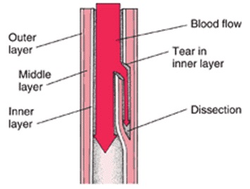 Pathophysiology of Aortic Dissections