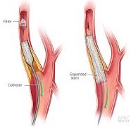 Carotid Stent with Filter