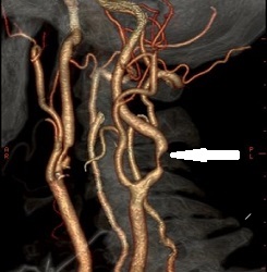 CTA - Carotid Stenosis