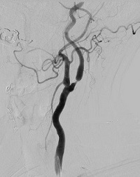 Carotid Angiogram - Carotid Stenosis