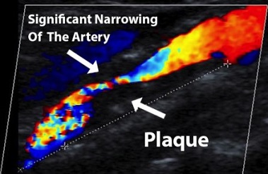 Carotid Duplex - Carotid Stenosis