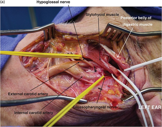 Carotid Vessel Exposure