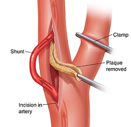 Carotid Shunt