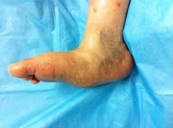 Charcot Foot