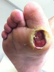 Chronic Diabetic Plantar Foot Ulcer