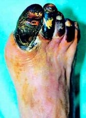 Dry Gangrene - Foot