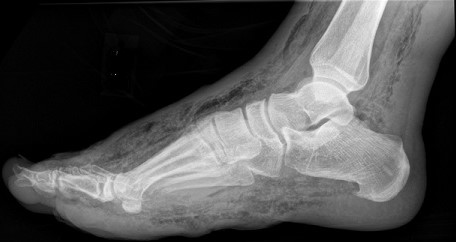 Gas Gangrene - Diabetic Foot