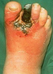 Wet Gangrene - Foot