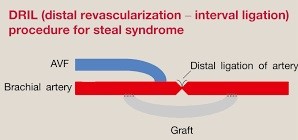 Distal Revascularization, Interval Ligation Procedure for Steal Syndrome