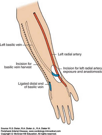 Forearm Basilic-Radial Transposition Fistula