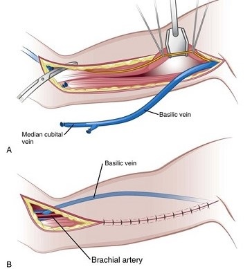 Brachiobasilic Fistula