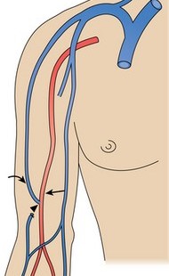 Brachiocephalic Fistula