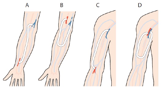 Prosthetic Fistulas