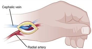 Radiocephalic Fistula