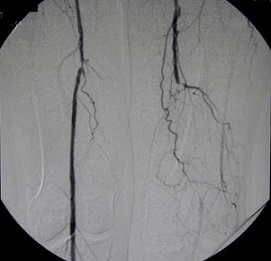 Angiogram - SFA Stenosis and Occlusion