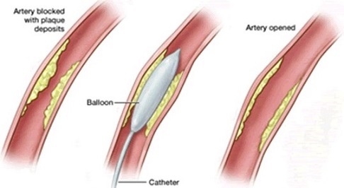 Balloon Angioplasty