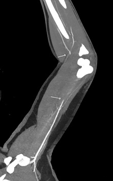 CTA - Brachial Artery Occlusion