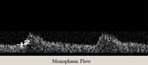 Monophasic Flow