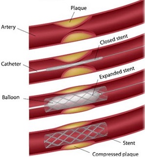 Balloon Expanding Stent Angioplasty