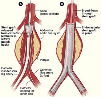 Stent Graft