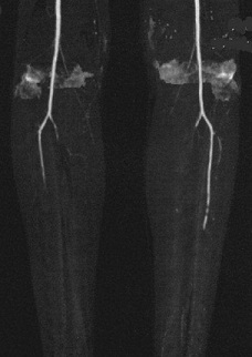 MRA - Bilateral Tibioperoneal Disease