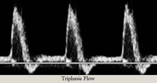 Triphasic Flow