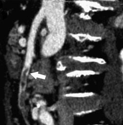 SMA Embolus - CTA