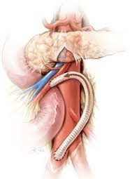 SMA Retrograde Bypass