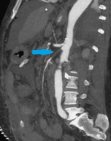 SMA Thrombosis - CTA