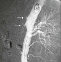 SMA Chronic Thrombosis