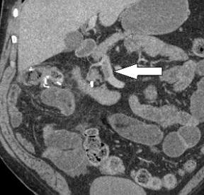 SMV Thrombosis