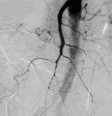 Nonocclusive Mesenteric Ischemia