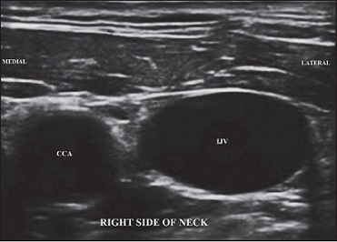 Internal Jugular Vein + Carotid Artery - Ultrasound