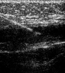 Needle Entering the Internal Jugular Vein - Ultrasound