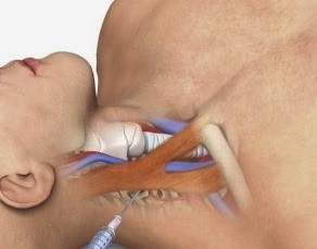 Posterior IJ Central Line Approach