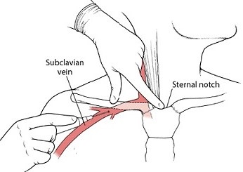 Subclavian Vein Cdntral Line Insertion