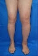 Stage I Lymphedema