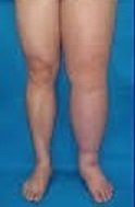 Stage II Lymphedema