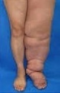 Stage III Lymphedema