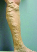 Varicose Veins