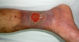 Venous Stasis Ulcer